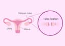 Tubal Ligation