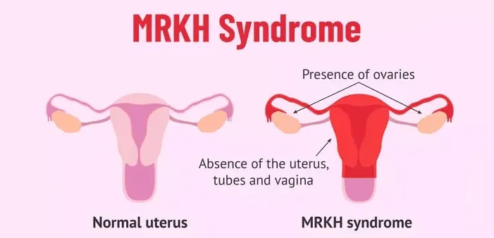 MRKH Syndrome