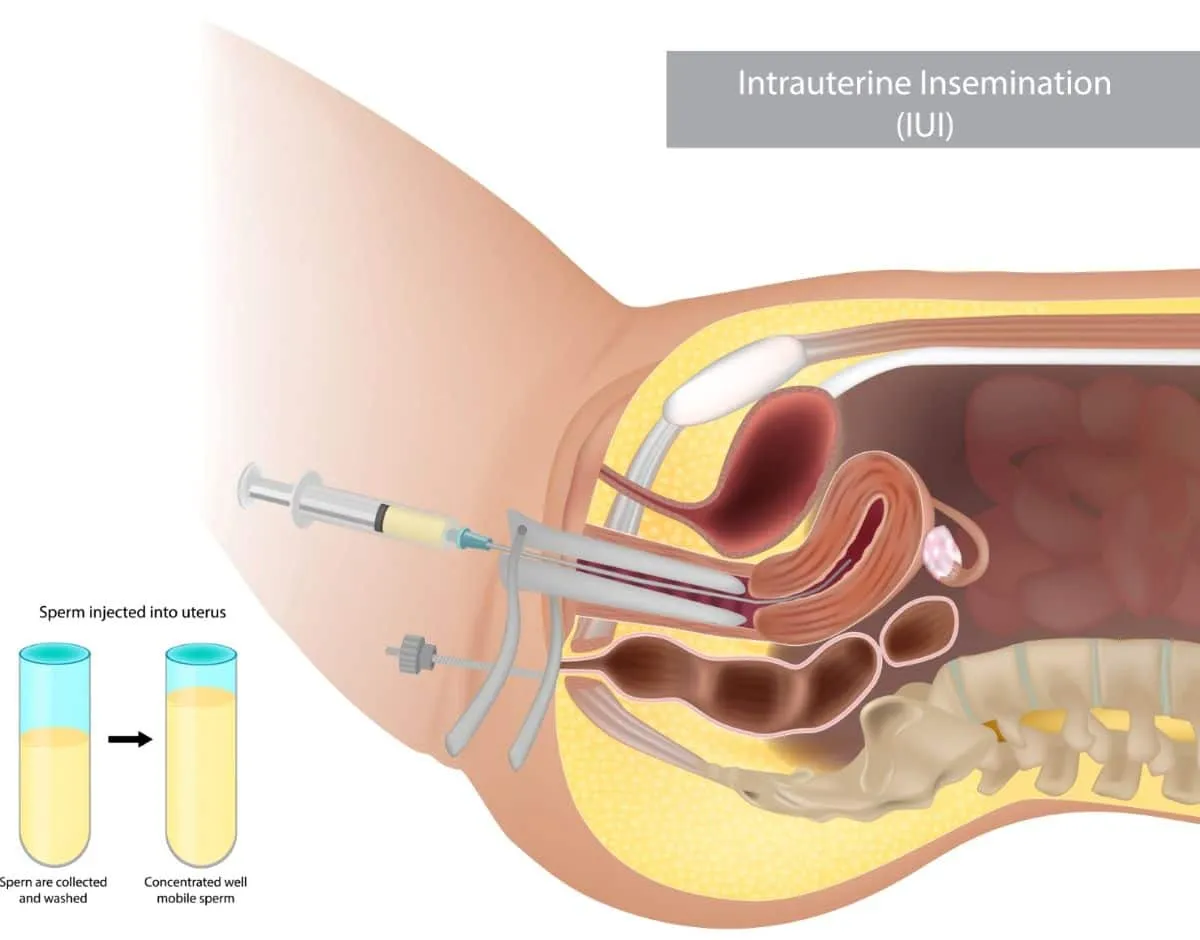 iui