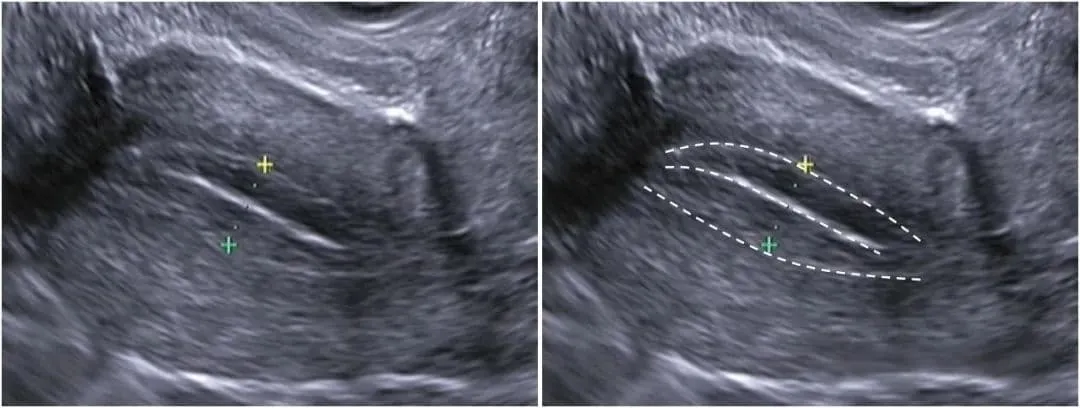 trilaminar endometrium